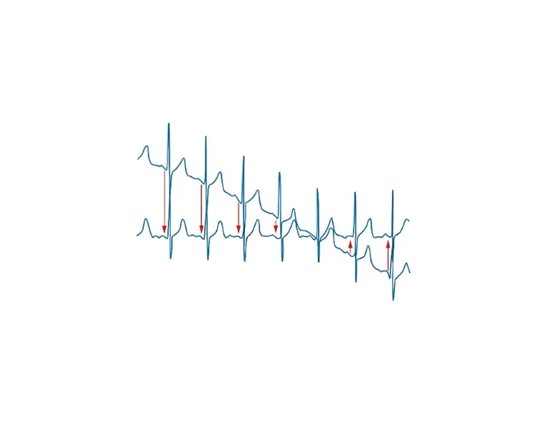 Уникальная система фильтрации ЭКГ