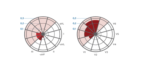 BTL-Cardiology_ST-maps_vector2