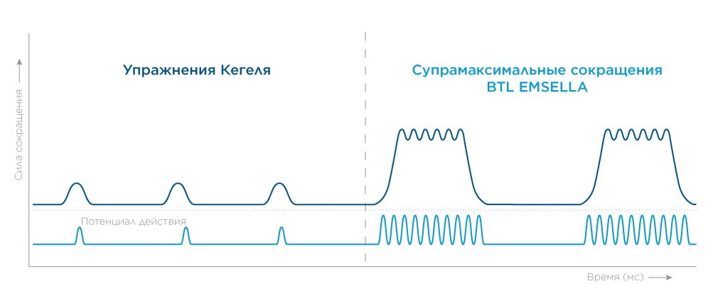 BTL Emsella Как работает технология HIFEM