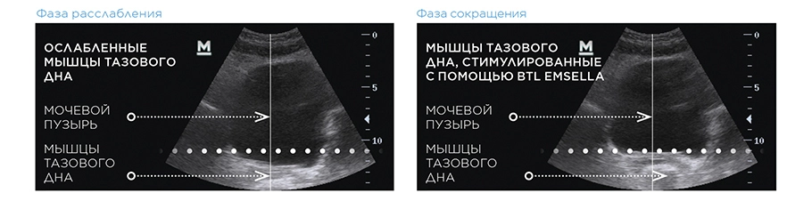 Emsella_scientic