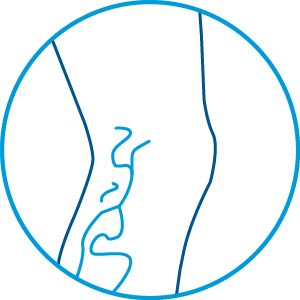 Венозная недостаточность