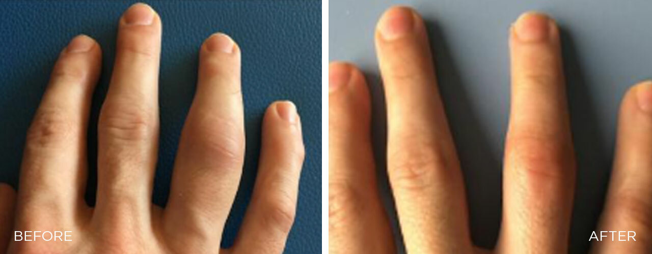 SIS-BA-2-bone-edema