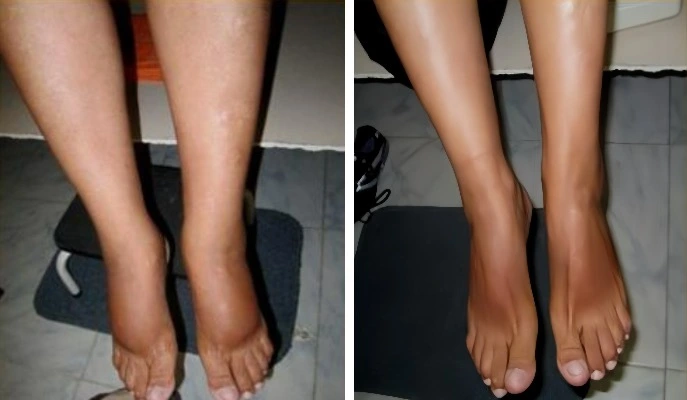 Ноги женщины до и после проведения процедур на аппарате прессотерапии