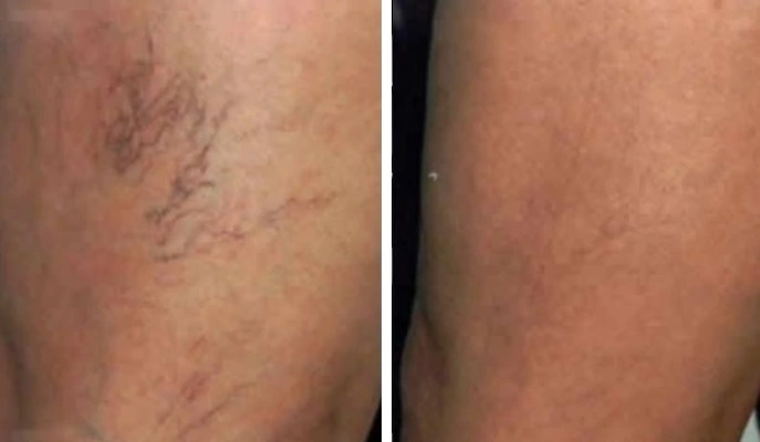 Фото ног пациента с варикозом до и после проведения процедур на аппарате прессотерапии