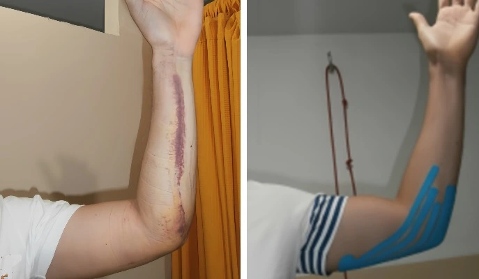 Рука пациентом со шрамом до проведения процедур на аппарате прессотерапии, а также рука без шрама после