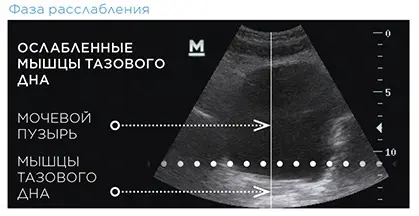 УЗИ До