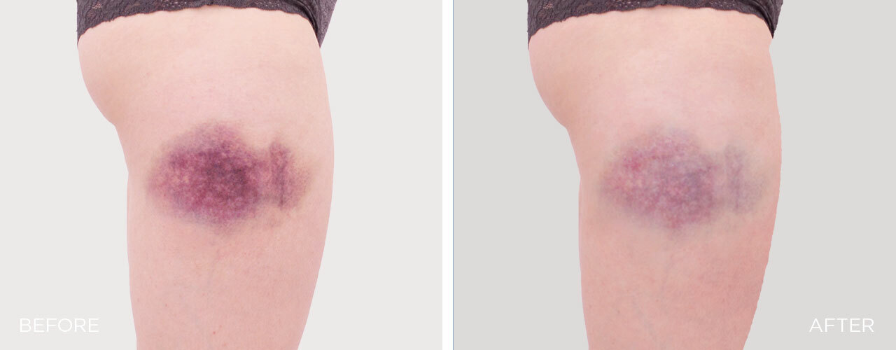 HIL-BA-Sport-injury