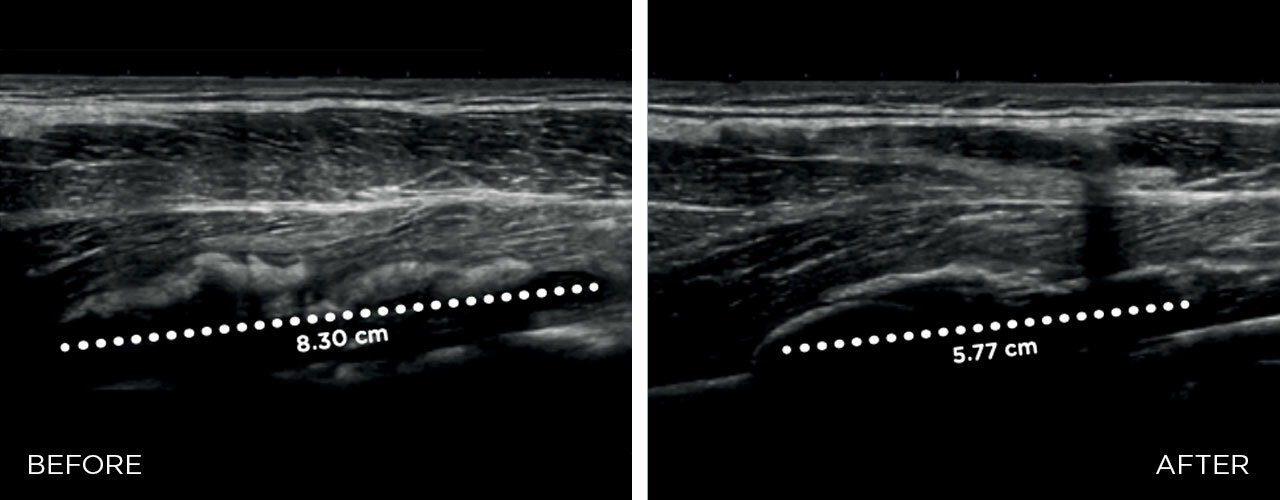 HIL-BA-muscle-injury_1653376888_original