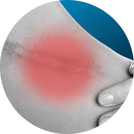Myofascial_syndrome_ICON_130x130px_EN100