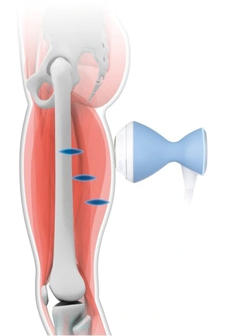 Фокусированная ударно-волновая терапия