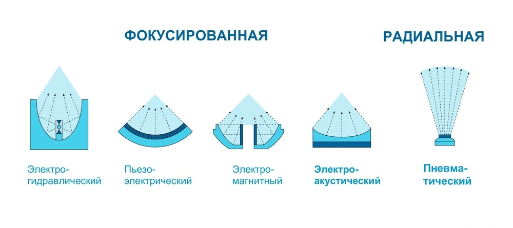 Типы ударно-волновой терапии