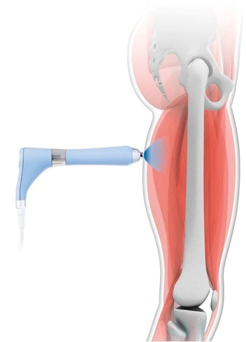 Радиальная ударно-волновая терапия