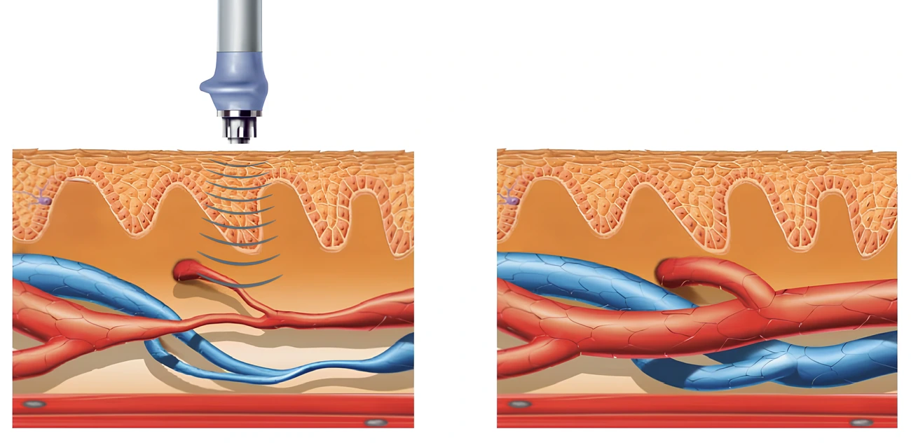 Процесс неоваскуляризации с УВТ
